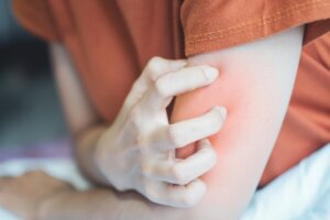 Cómo cuidar la piel con urticaria crónica en verano