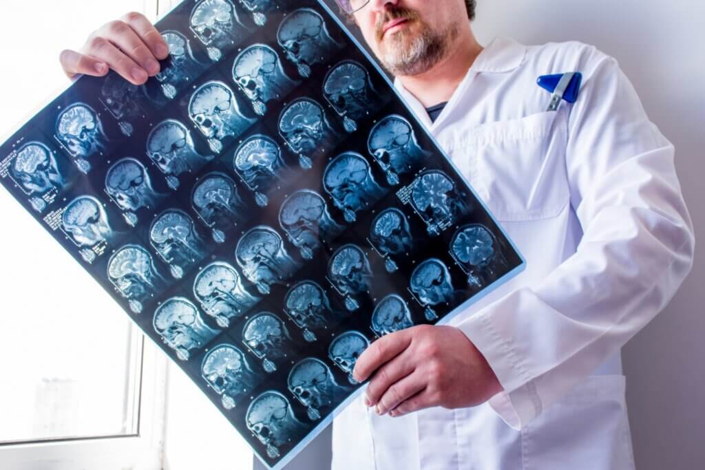 La sustancia blanca del cerebro se asocia a la esclerosis múltiple