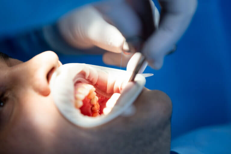 7 tipos de implantes dentales y sus características