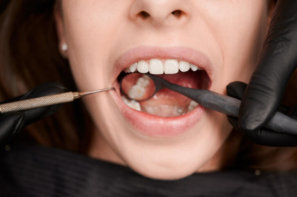 Para prevenir caries hay que acudir al odontólogo