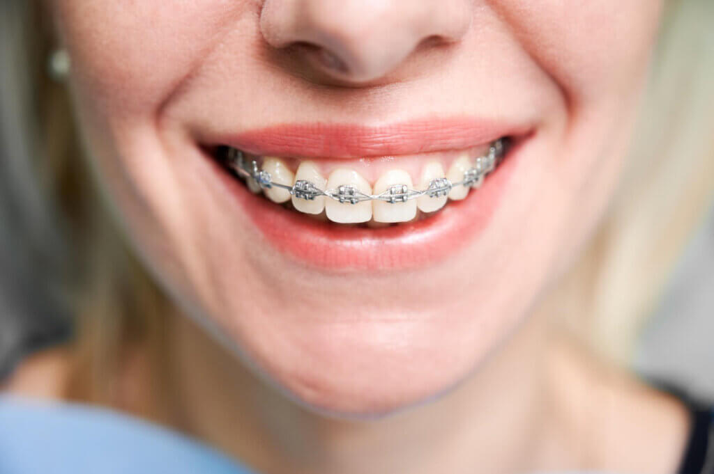 Que tratamentos existem para alinhar os dentes?