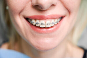 ¿Qué tratamientos existen para alinear los dientes?