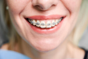 What Treatments Exist to Align Teeth?