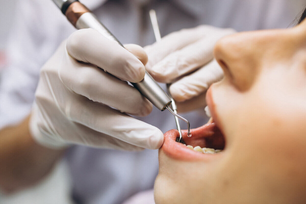 Diferencias entre la endodoncia y el empaste: ¿cuál necesito?