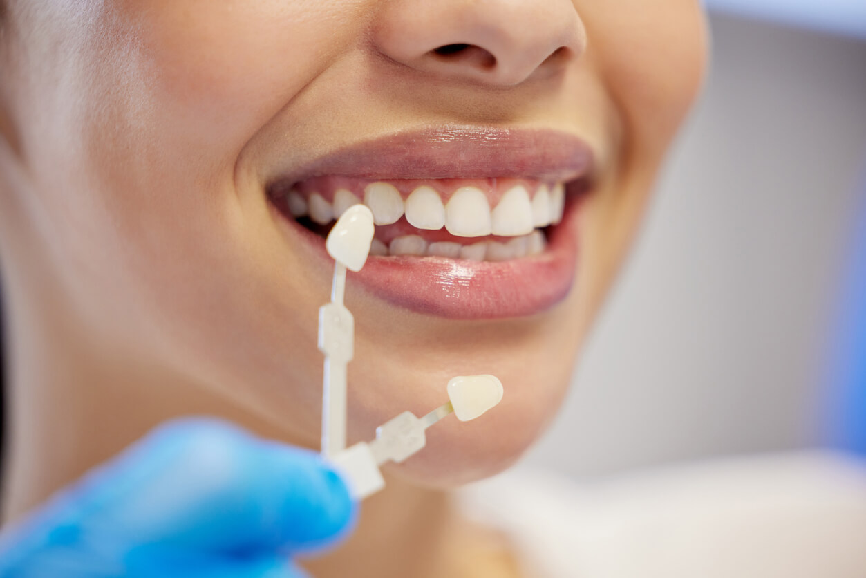 Carillas dentales: cuándo se recomiendan y cómo usarlas