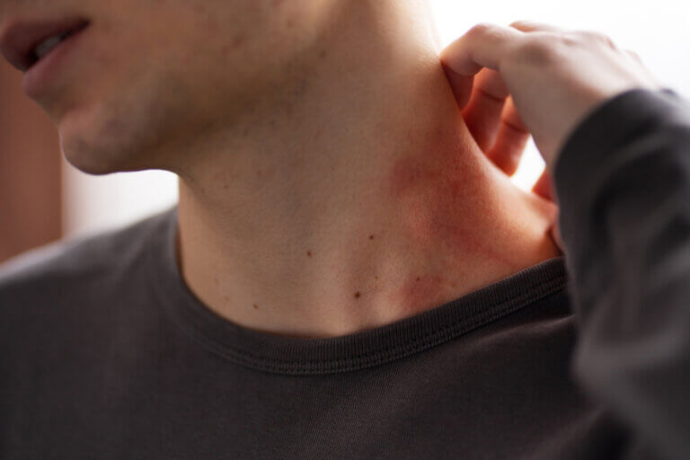 Granos en el cuello: Por qué aparecen y qué hacer para disminuir la picazón