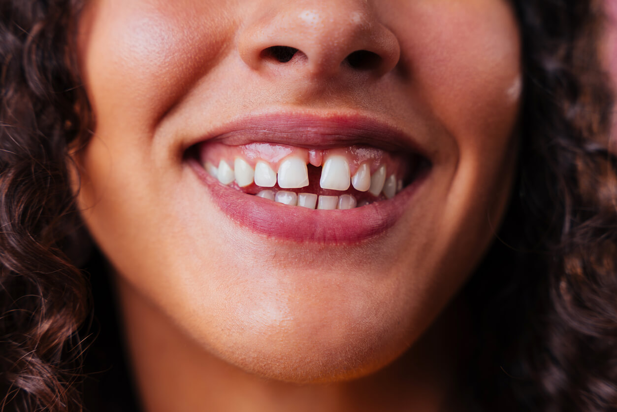 Diastema: por qué mis dientes se separan y cómo corregirlo