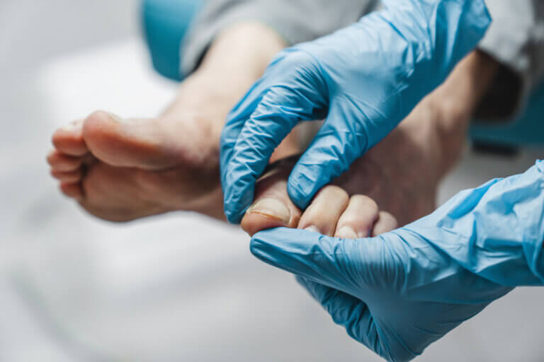 Los tipos de hongos más comunes en las uñas de los pies incluyen los hongos no dermatofitos