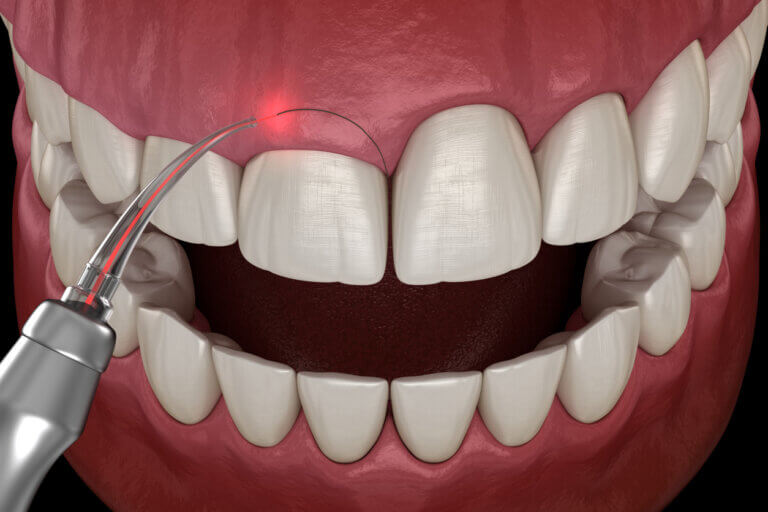 La gingivectomía puede hacerse con láser