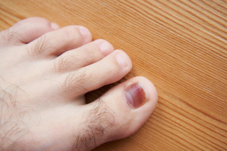 El sangrado subungueal es una enfermedad de la uña frecuente