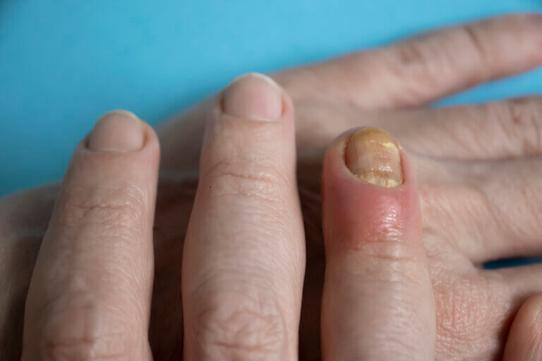 La paroniquia es una de las enfermedades de las uñas