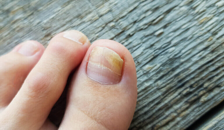 La onicomicosis es una de las enfermedades de las uñas