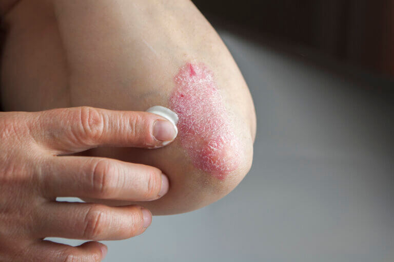 La psoriasis es una de las enfermedades de las uñas más frecuentes