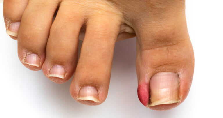 Las uñas encarnadas son enfermedades de las uñas frecuentes