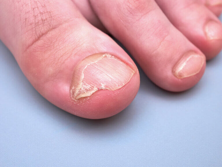 Los tipos de hongos más comunes en las uñas de los pies incluyen las levaduras