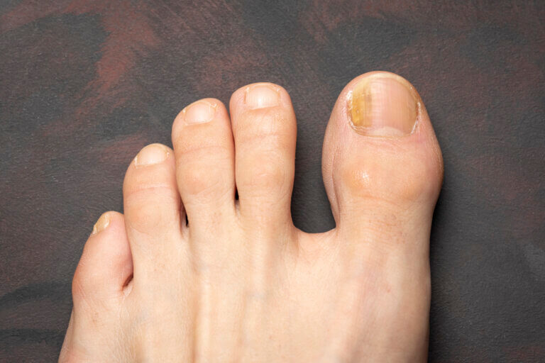 Los tipos de hongos más comunes en las uñas de los pies incluyen los dermatofitos