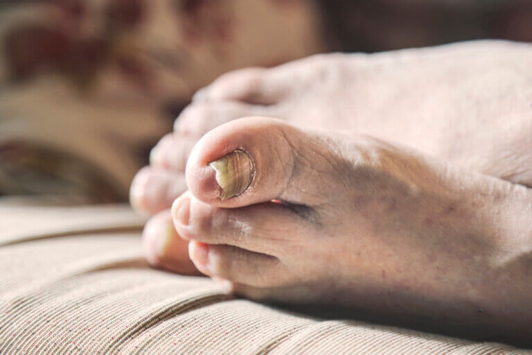 Tipos de hongos más comunes en las uñas de los pies