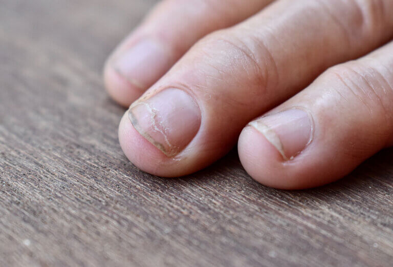 Las uñas quebradizas son enfermedades de las uñas comunes