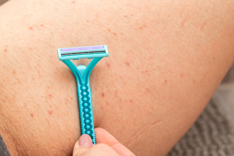 Foliculitis por depilación: qué es, cómo tratarla y prevenirla