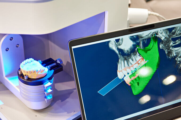Implantes dentales sin tornillos ni cirugía, ¿funcionan?