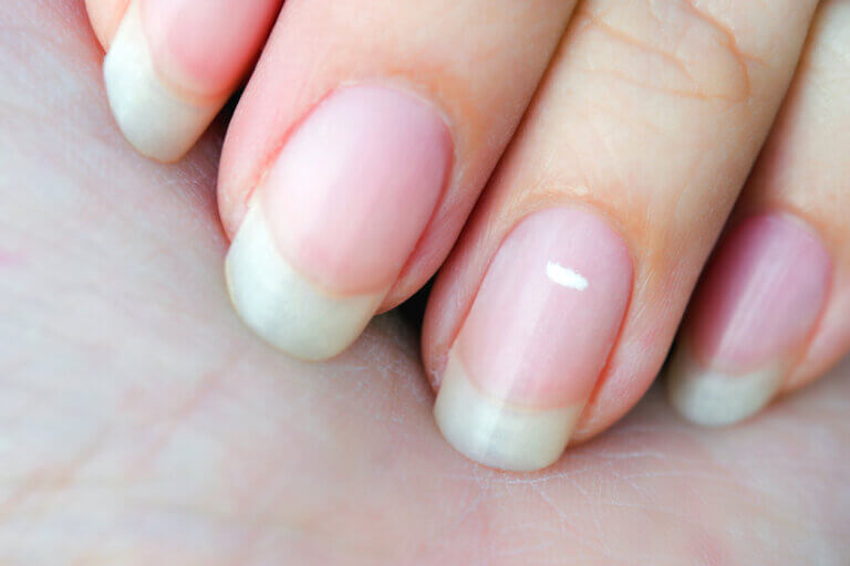¿Qué significan las manchas blancas en las uñas y cómo tratarlas?