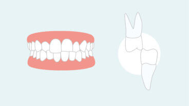 Mordida cruzada: consecuencias y opciones de tratamiento