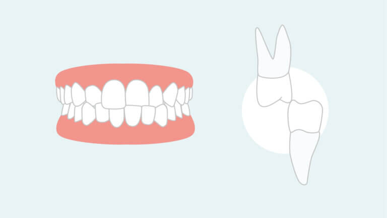 Mordida cruzada: consecuencias y opciones de tratamiento