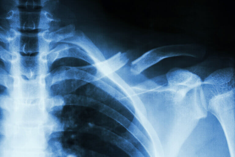 Radiografía de fractura de clavícula izquierda una causa de dolor de la clavícula