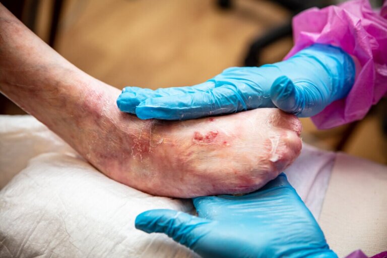 Maladie de la peau du papillon : causes, symptômes et diagnostic