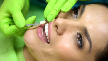 Ventajas y desventajas de las carillas de composite