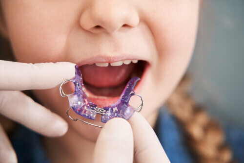 An orthodontis putting a purple retainer into a small child's mouth.