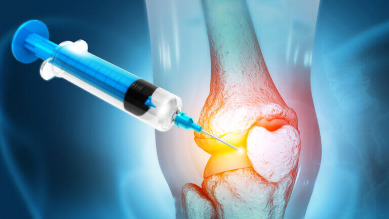 Preguntas frecuentes sobre la infiltración de rodilla