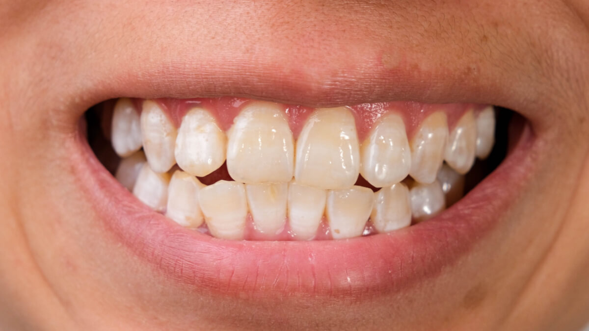 Manchas blancas en dientes con caries.
