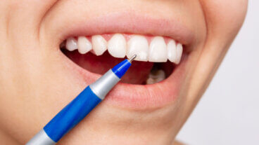 ¿Por qué aparecen manchas blancas en los dientes y cómo prevenirlas?