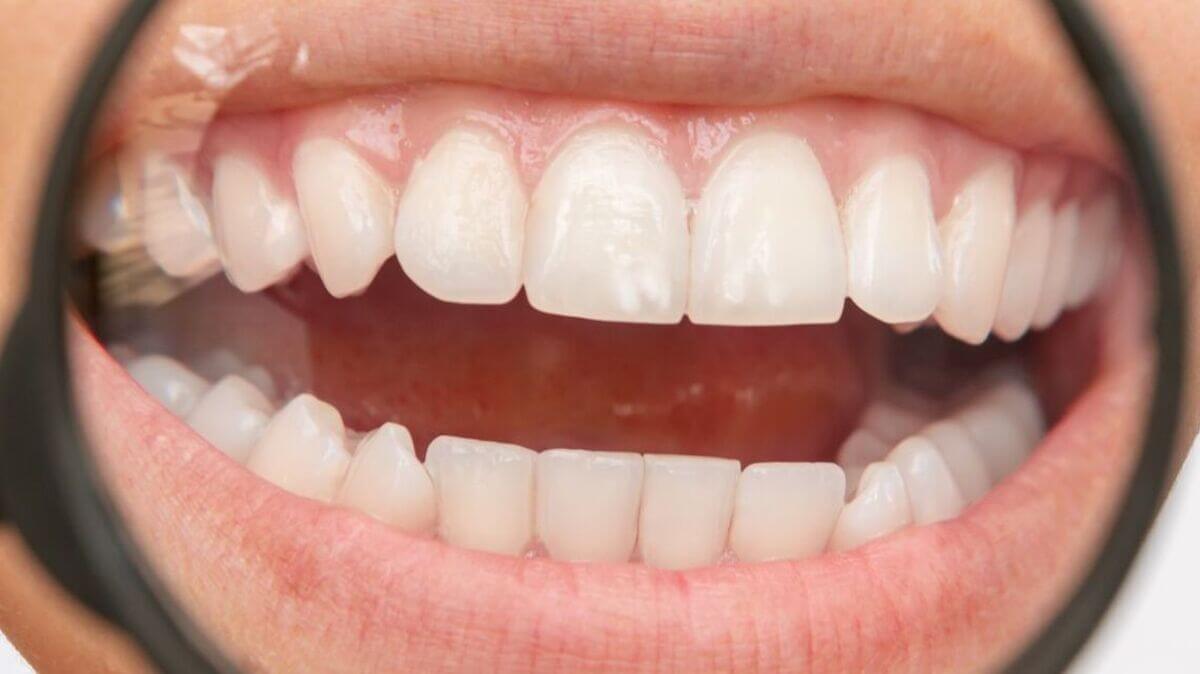 Fluorosis causa manchas blancas en dentadura.