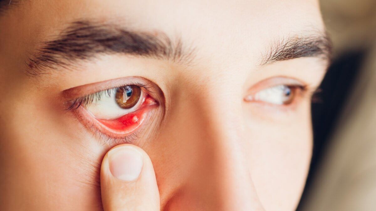 Orzuelo dentro del párpado.