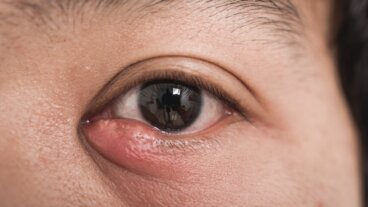 ¿Cómo tratar los orzuelos y evitar su reaparición?