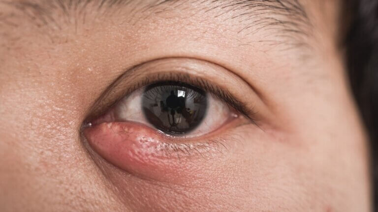 ¿Cómo tratar los orzuelos y evitar su reaparición?