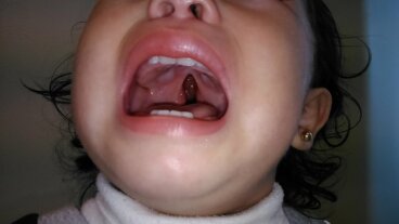 Labio leporino y paladar hendido: todo lo que debes saber